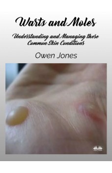 Warts And Moles-Understanding And Managing These Common Skin Conditions